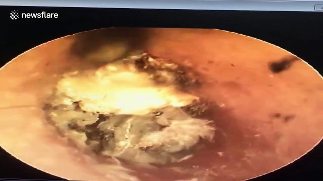 Doctor in Vietnam removes 'thousands of mushrooms' from man's ear