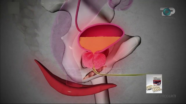 Hipokrati - Prostata - Çfarë është Prostatiti dhe Zmadhimi i Prostatës – 20 Qershor 2020