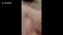 US man's 'partially artificial' heart seen beating through chest scar