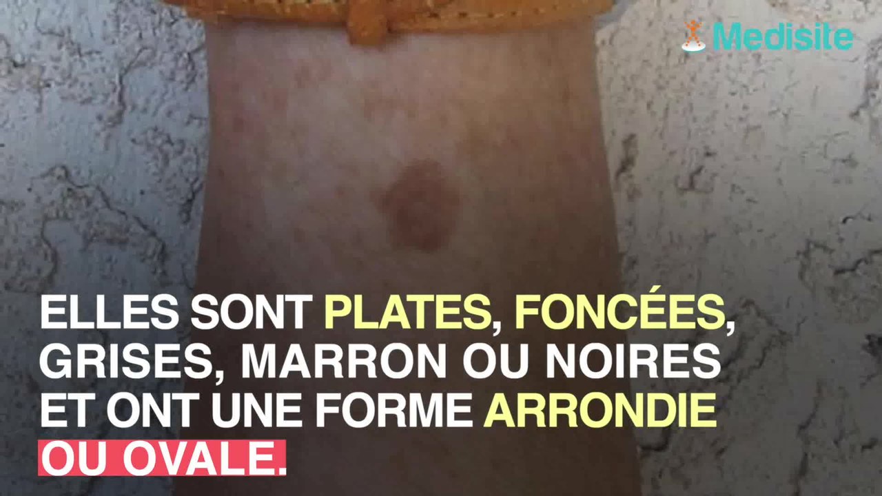 Taches brunes : qu'est-ce que c'est ?