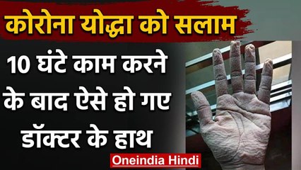 Viral Pic Coronavirus : 10 घंटे काम करने के बाद ऐसे हो गए डॉक्टर के हाथ | वनइंडिया हिंदी