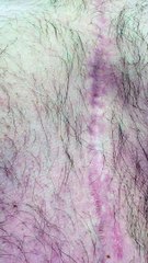 Partial Artificial Heart Beating in Chest