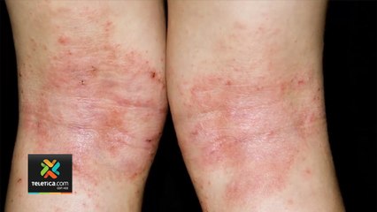 tn7-mayores-cuidados-a-quienes-padecen-dermatitis-240620