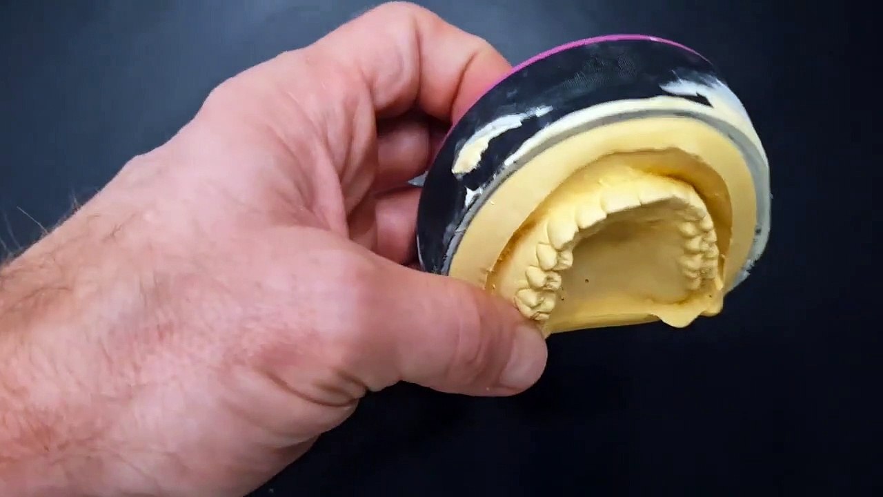 Zahnarzt- Zahnabdruck für Tiefziehschiene