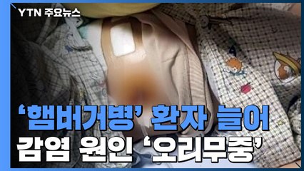 안산 유치원 식중독 106명에 햄버거병 15명...원인은 오리무중 / YTN