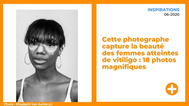 Cette photographe capture la beauté des femmes atteintes de vitiligo : 18 photos magnifiques