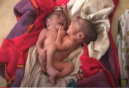 Miracle Baby born with 2 heads, 4 arms and 2 legs, in India