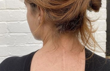 Princesa Eugenie pede que portadores de escoliose compartilhem suas cicatrizes