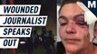 A wounded journalist speaks out — Mashable Originals