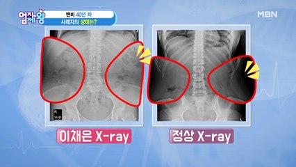 변비 40년차의 주인공! 그녀의 상태는?