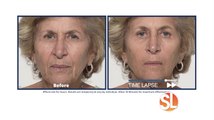 Have you taken the Plexaderm 10-minute challenge to shrink under-eye bags and wrinkles?