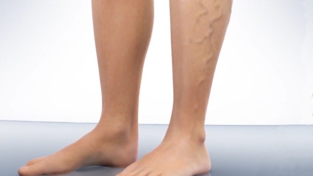 bd-hablamos-sobre-inflamacion-de-las-venas-300620