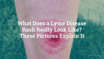 What Does a Lyme Disease Rash Really Look Like? These Pictures Explain It