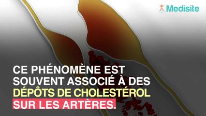 Plus vous mangez de viande rouge, plus vos artères vieillissent !