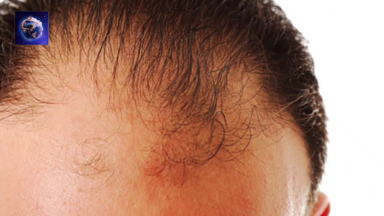 Best Hair Fall Solution __ Promote Regrowth of New  Hair __  Dandruff __ Home Solution __ Hindi