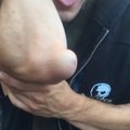 Guy Shows off Bump on Elbow Post Skateboarding Fail