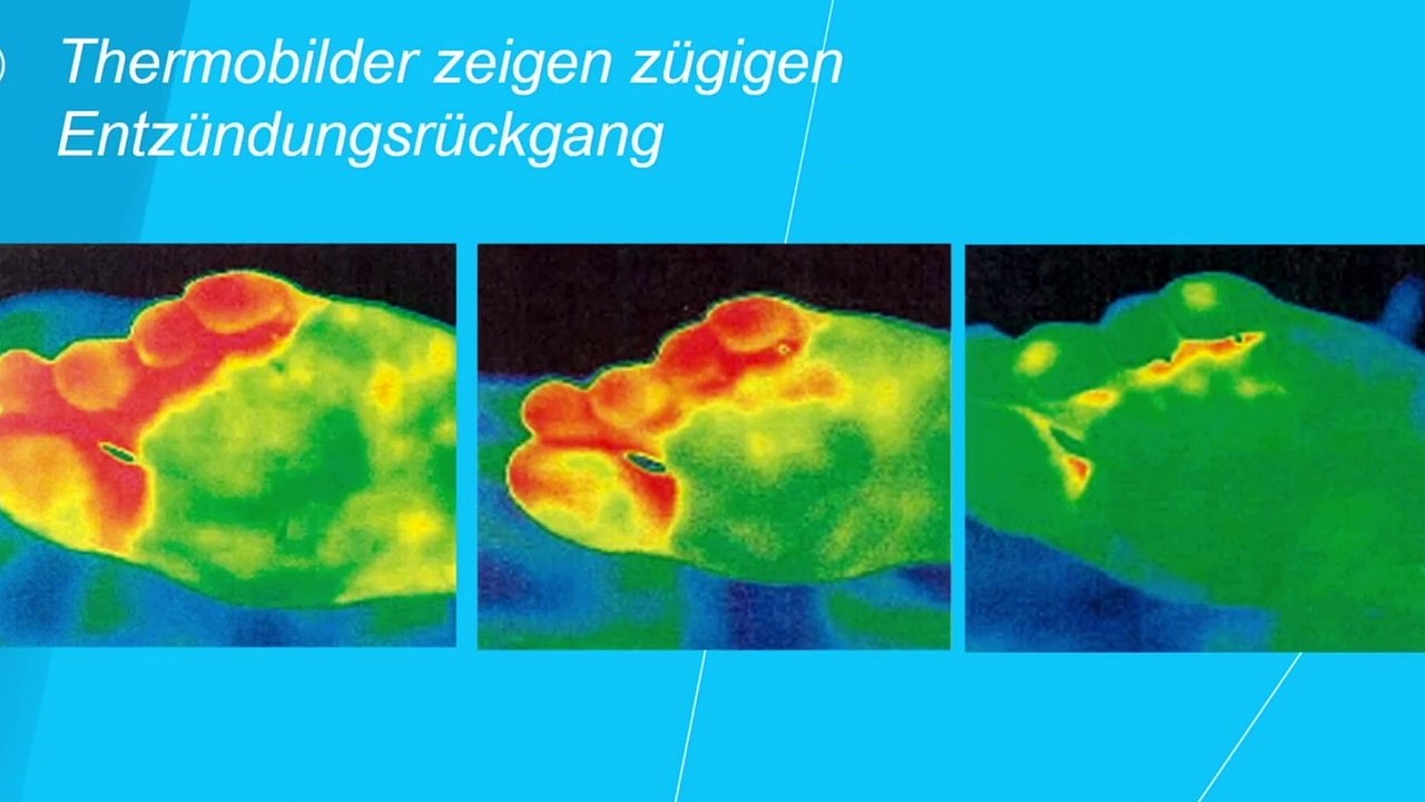Fusspilz durch Sport - So können Sie sich schützen!