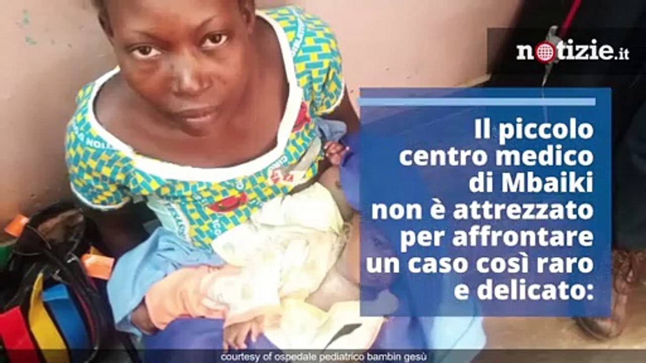Unite per la testa: separate due gemelle siamesi al Bambino Gesù di Roma | Notizie.it