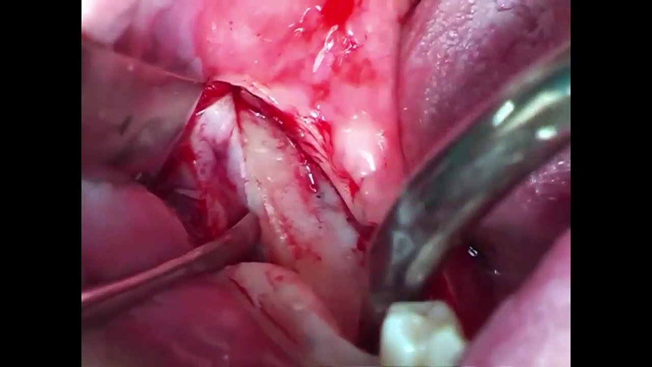 Zahnärzte: Blockaugmentation Freiende v. Kieferwinkel