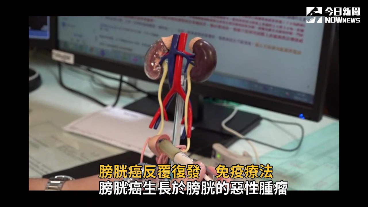 膀胱癌反覆復發　免疫療法治療見效