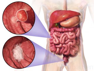 What is Colorectal Cancer