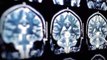 Alarming New Study Warns COVID-19 May Cause Severe Neurological Complications