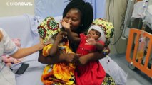 Irmãs siamesas separadas em hospital do vaticano