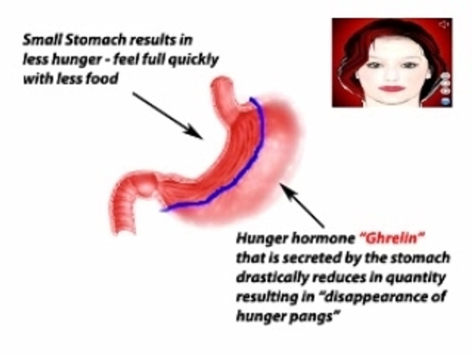 What is Gastric Sleeve? Best Cost Hospitals