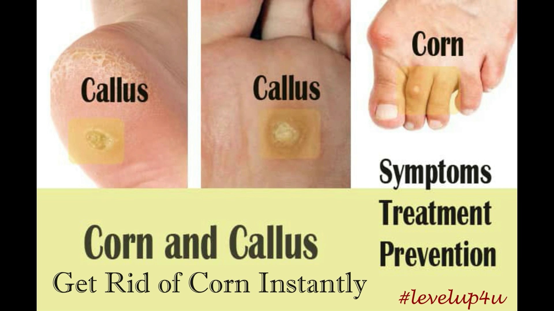 get rid of corns on feet