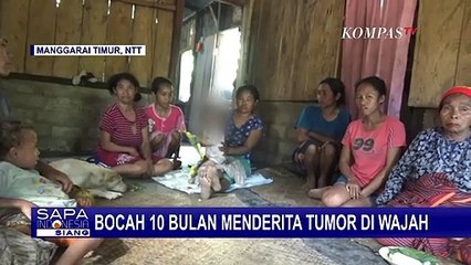 Derita Tumor Wajah, Pengobatan Tesiana Terhambat Biaya
