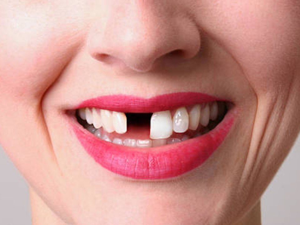 Mut zur Lücke: Moderatorin verliert vor laufender Kamera Schneidezahn