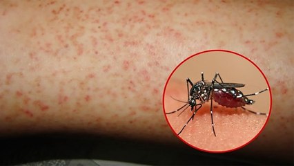 Sốt xuất huyết khó ngăn chặn nếu người dân chủ quan