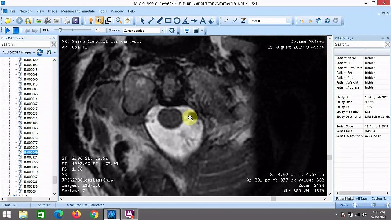 Parasite Worms Infection / Infestation Appears In My MRI Images