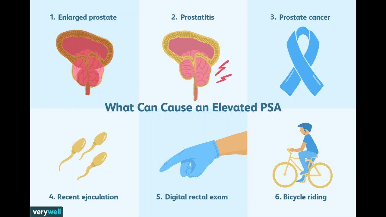 Following PSA Levels During and After Prostate Cancer Treatment