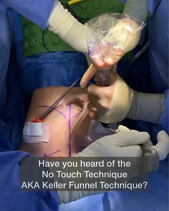 Keller Funnel Surgery - Beverly Hills Plastic Surgery Inc