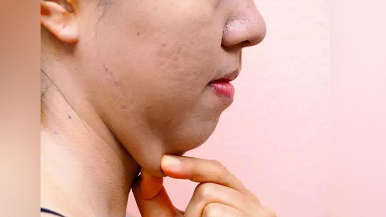 Double Chin से बिना Exercise हफ्तेभर में पाएं छुटाकारा, होंगे हैरान कर देने वाले फायदे । Boldsky