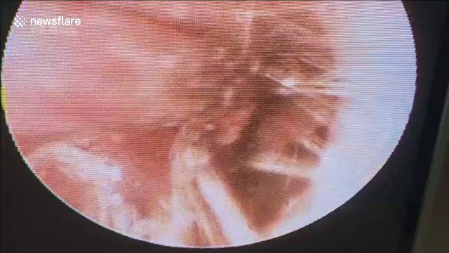 Doctor removes living butterfly from man's ear in Vietnam