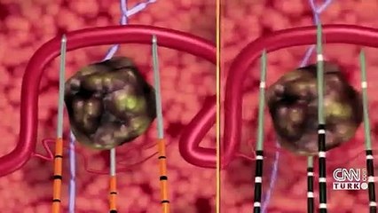 Son Dakika: Hepatit için erken teşhis önemli | Video