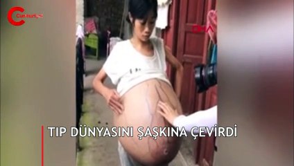 Aniden şişiyor... Tıp dünyasını şaşkına çevirdi