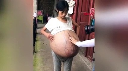 Karnında 20 kiloluk kütleli genç kadın tıp dünyasını şaşırttı!
