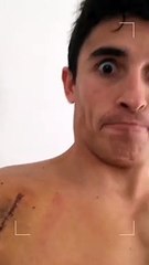 MotoGp, Marquez mostra la ferita alla spalla sui social