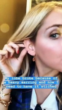 Piccolo incidente per Chiara Ferragni, l'influencer dal medico a Los Angeles