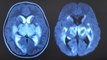 Links between brain disorders and coronavirus infections under investigation in the UK