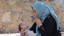 سوء التغذية يفتك بالأطفال السوريين في مخيمات النزوح