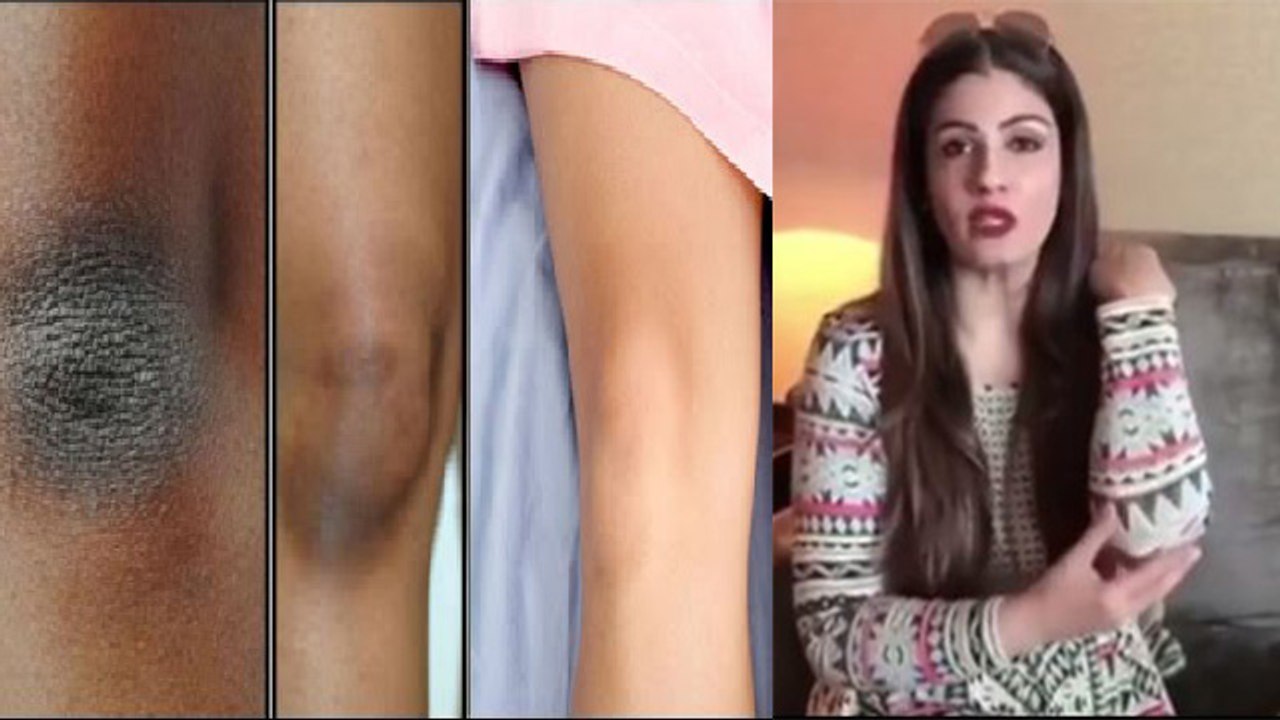 कोहनी का कालापन दूर करने के लिए Raveena Tandon के Tips को करें Follow ।Elbow Whitening Home Remedies