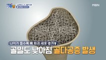 갱년기에 찾아온 골다공증
