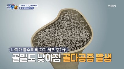 갱년기에 찾아온 골다공증