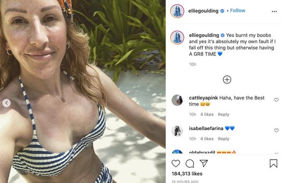 Ellie Scalding: Ellie Goulding burnt her boobs on holiday