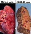 La photo d'un  poumon dévasté  par le Covid-19 fait  douter des  internautes,  mais elle est authentique