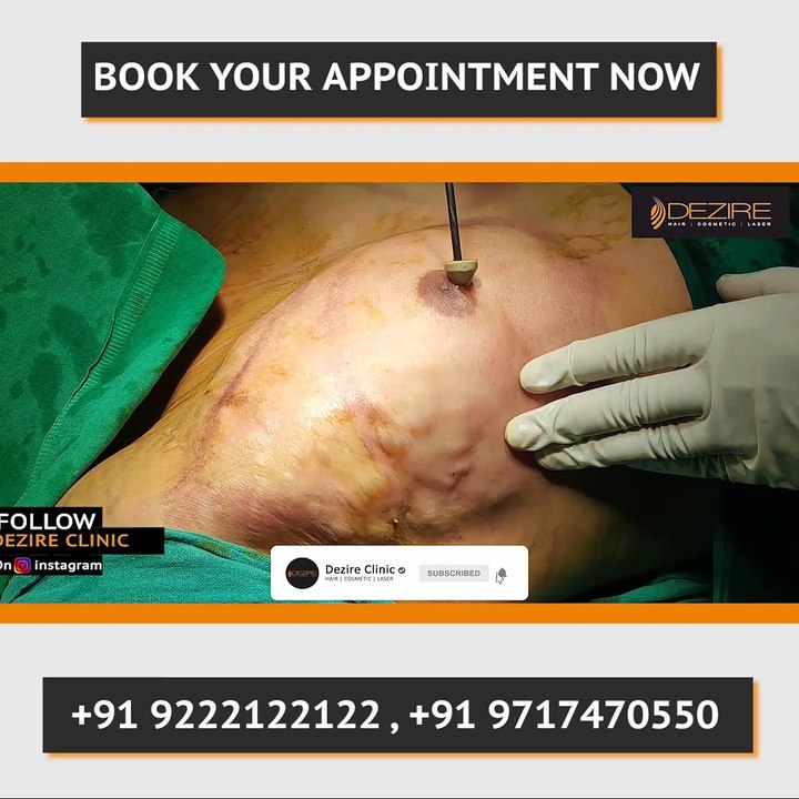 Gynecomastia Surgery in India . vaser liposuction and gland removal